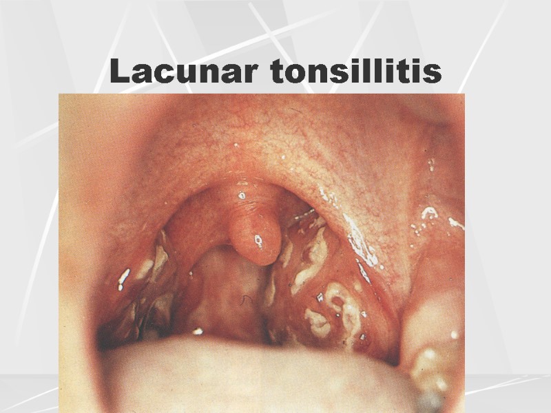 Lacunar tonsillitis